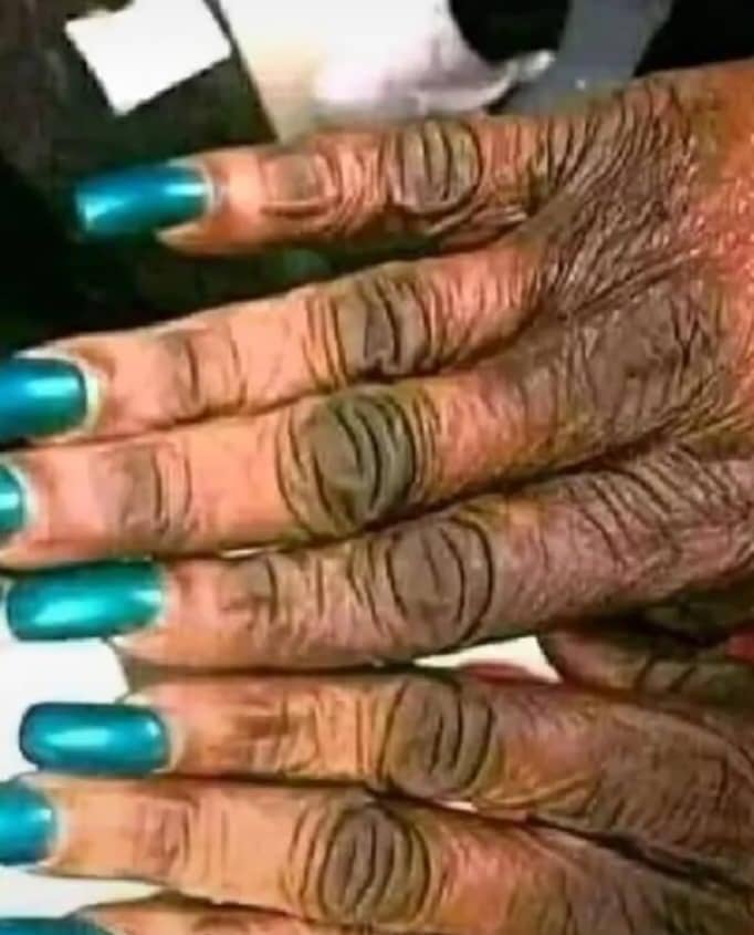 Santé-Attention : les produits dépigmentants à base d’hydroquinone augmentent le risque de cancer de la peau (Médecin)