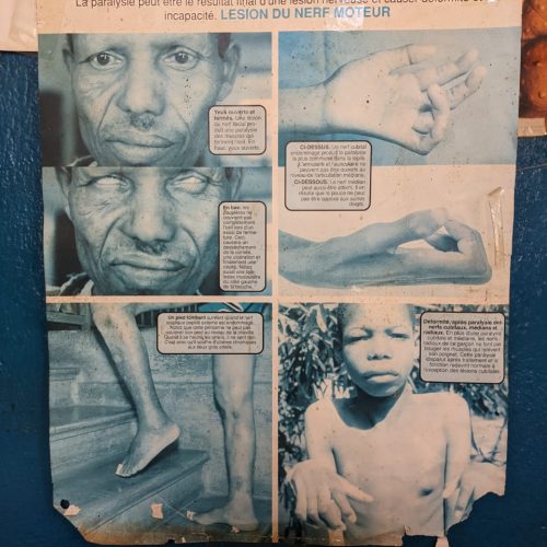 Journée mondiale des lépreux : à Oicha, la rupture prolongée des médicaments expose les patients à la stigmatisation et au risque de propagation